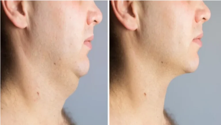 tighten neck skin exercises